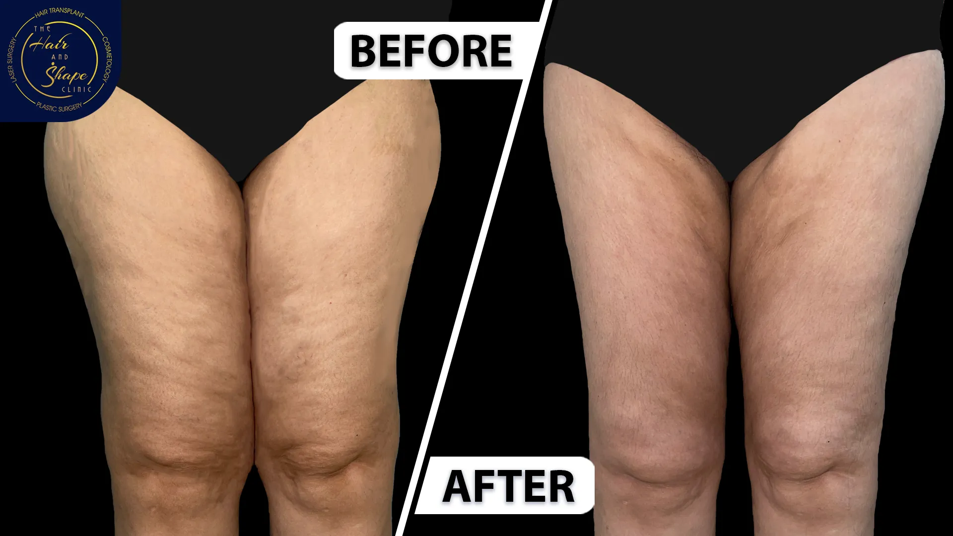 Thigh Liposuction result3